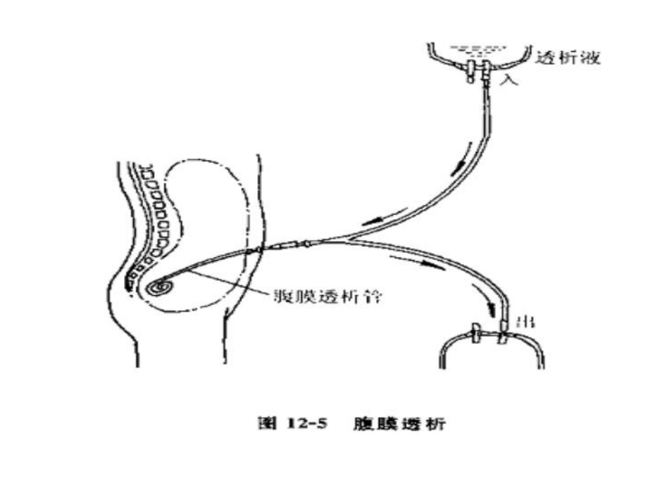 腹膜透析护理-ppt课件..ppt_第3页