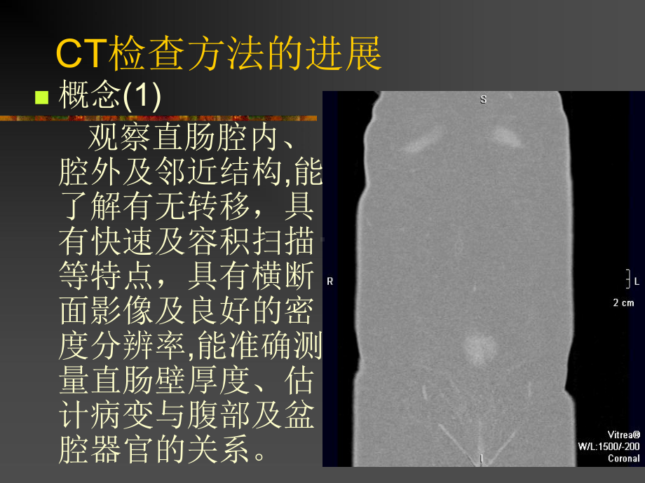 结直肠癌的CTMRI影像进展PPT课件.ppt_第3页