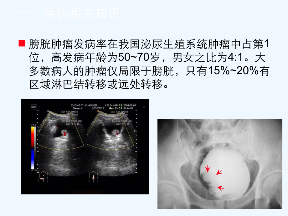 膀胱肿瘤病人的护理查房课件.ppt_第3页