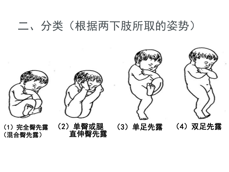 臀位分娩—ppt课件.ppt_第3页