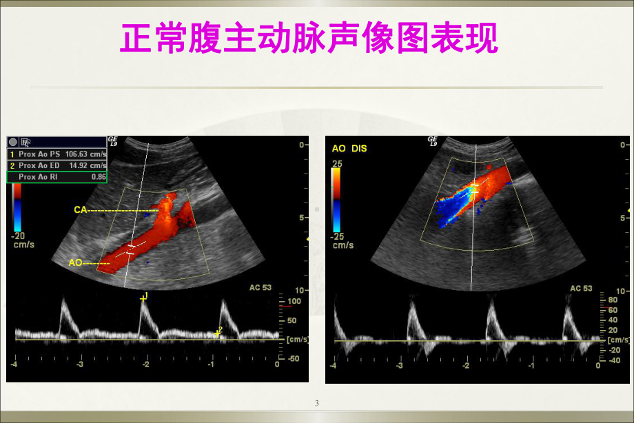 腹膜后大血管超声ppt演示课件.ppt_第3页