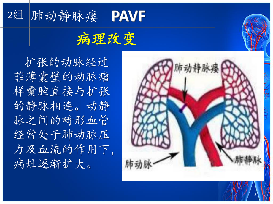 肺动静脉瘘PPT医学课件.ppt_第3页