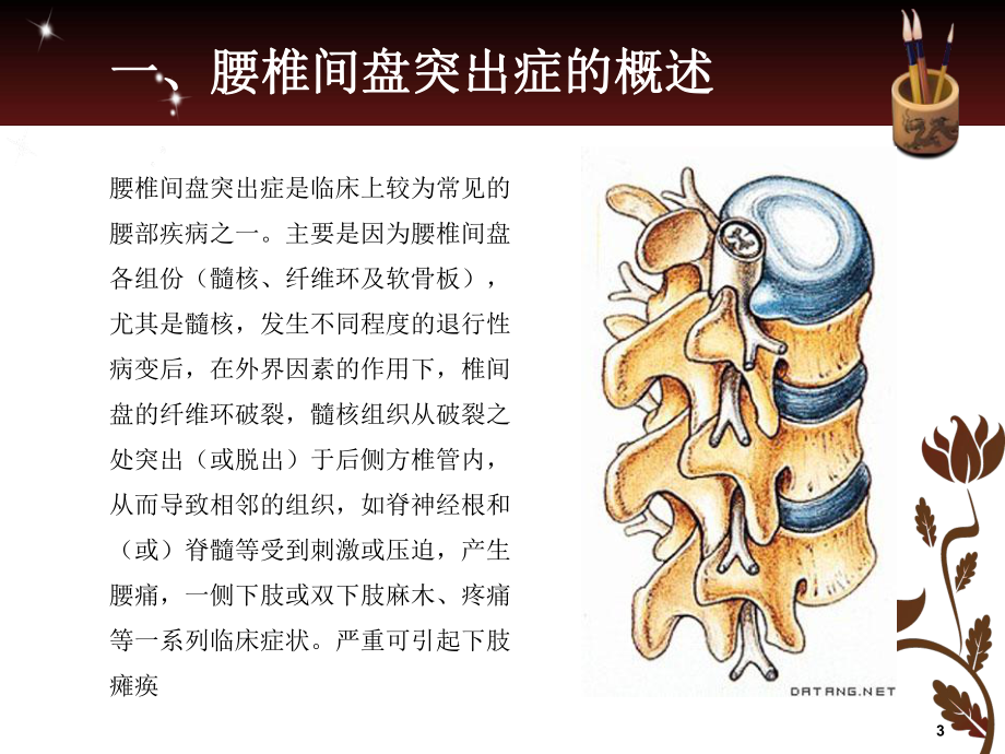 腰椎间盘突出症PPT优质课件.ppt_第3页