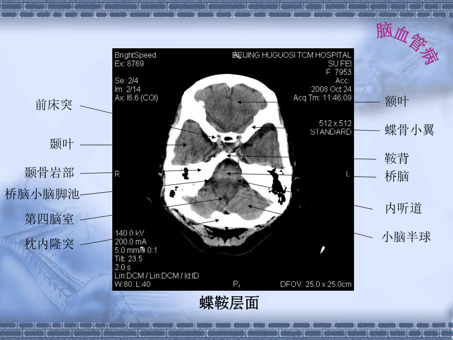 脑血管病影像诊断PPT课件.ppt_第3页