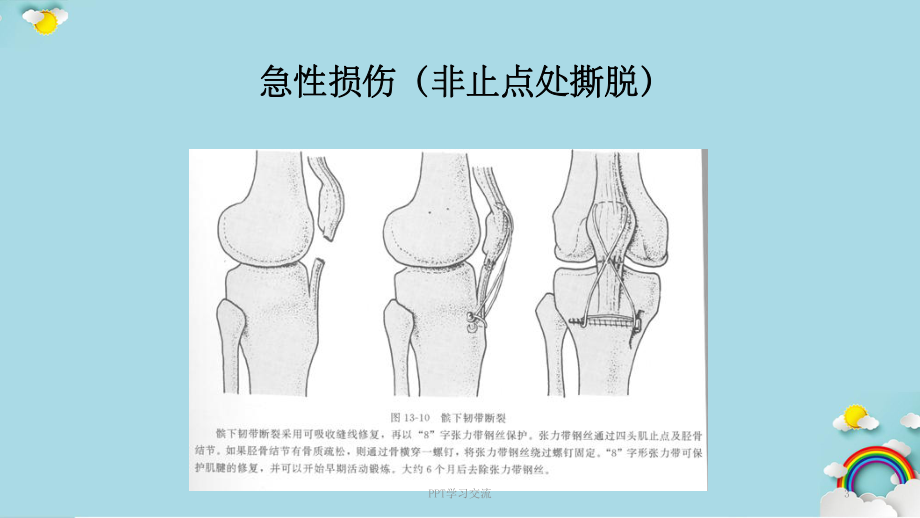 膝关节韧带损伤(膝关节稳课件.ppt_第3页