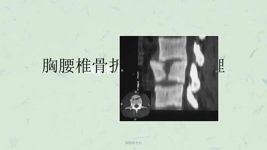 胸腰椎骨折课件.ppt_第1页