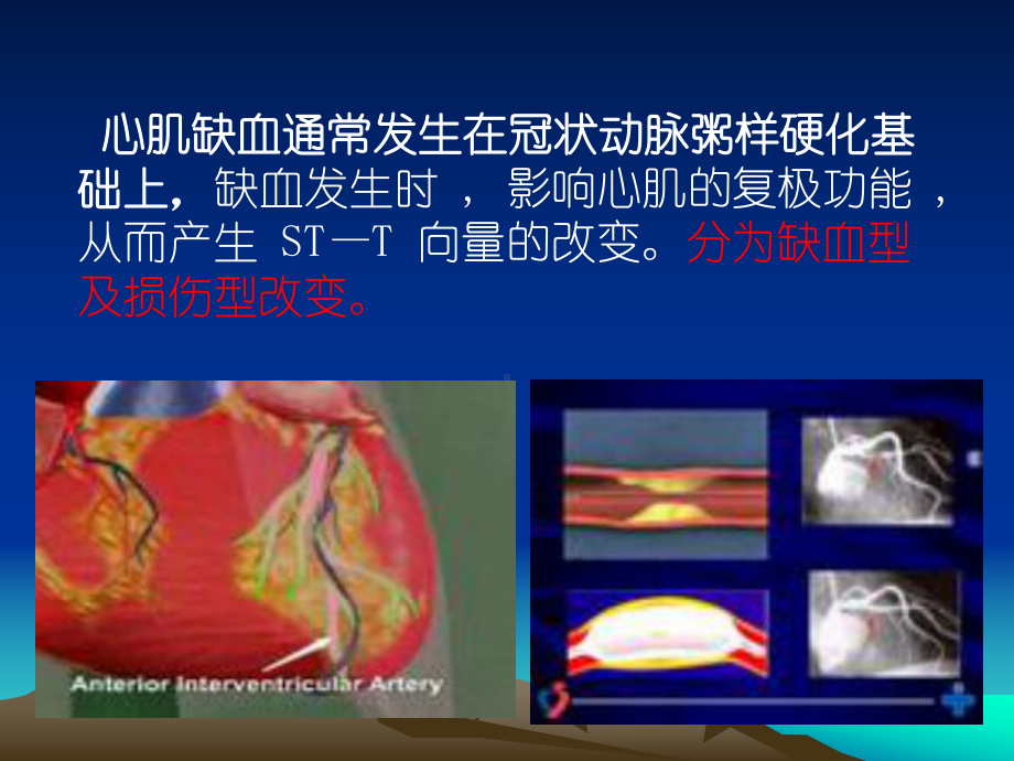 诊断学-16-心肌缺血心肌梗死课件.ppt_第3页