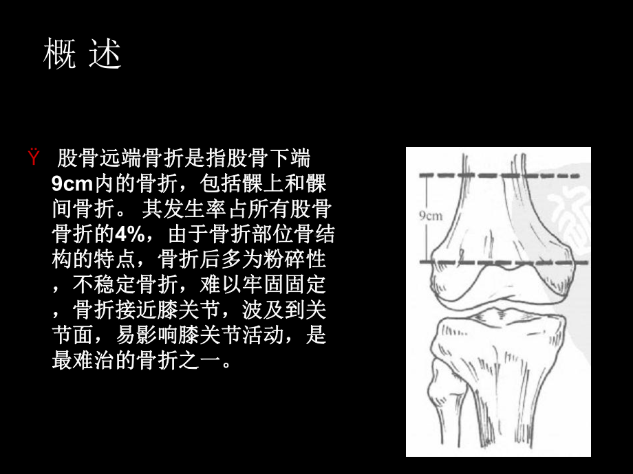 股骨远端骨折临床讲解ppt演示课件.ppt_第2页