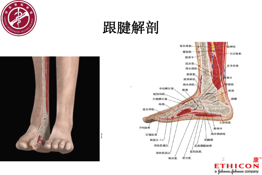 跟腱断裂术后康复流程PPT参考幻灯片课件.ppt_第2页