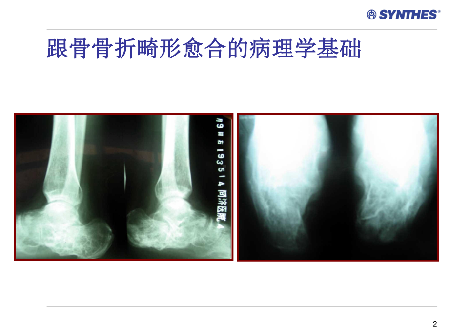 陈旧性跟骨骨折的手术治疗PPT幻灯片课件.ppt_第2页