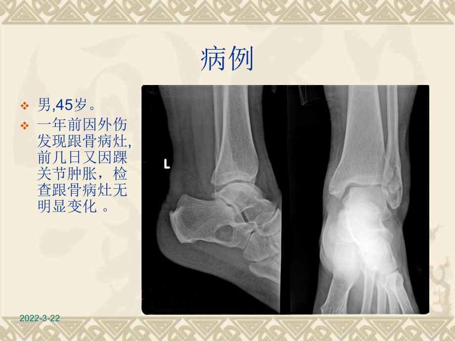 跟骨骨髓窦课件.ppt_第1页