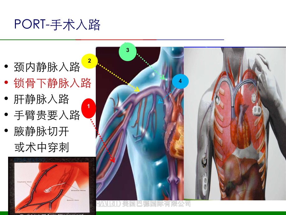 输液港护理查房PPT优质课件.ppt_第3页