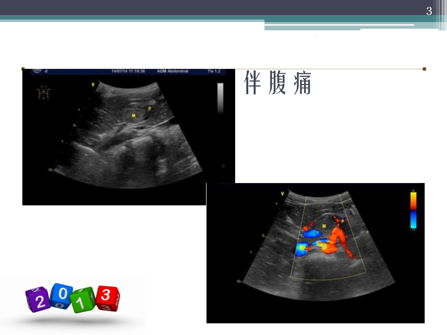 超声科腹组疑难病例讨论PPT医学课件.pptx_第3页