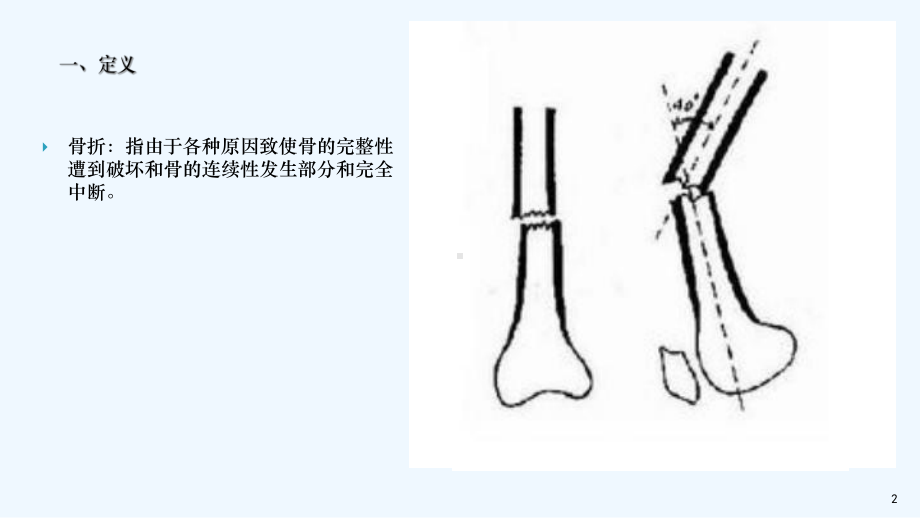 骨折患者的康复护理课件.ppt_第2页