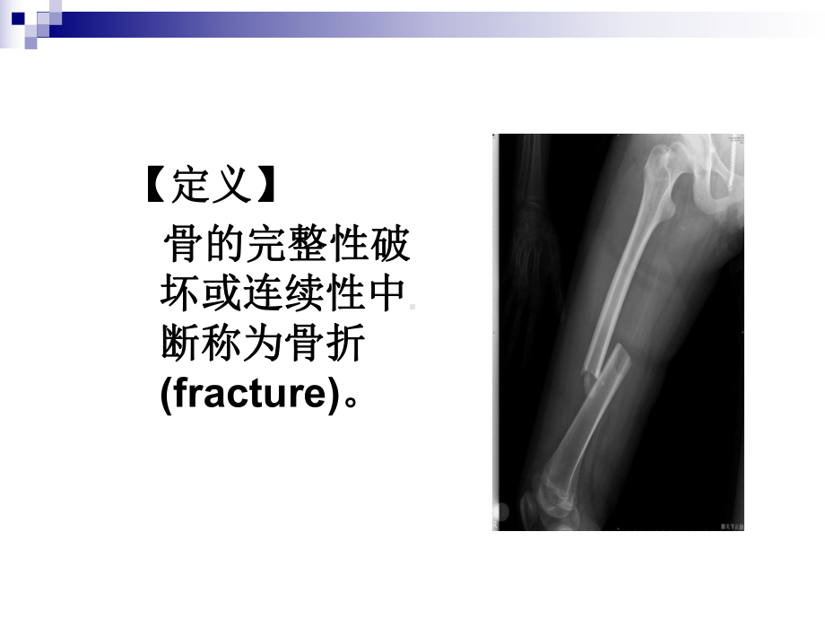 骨折的概述-ppt课件.ppt_第3页