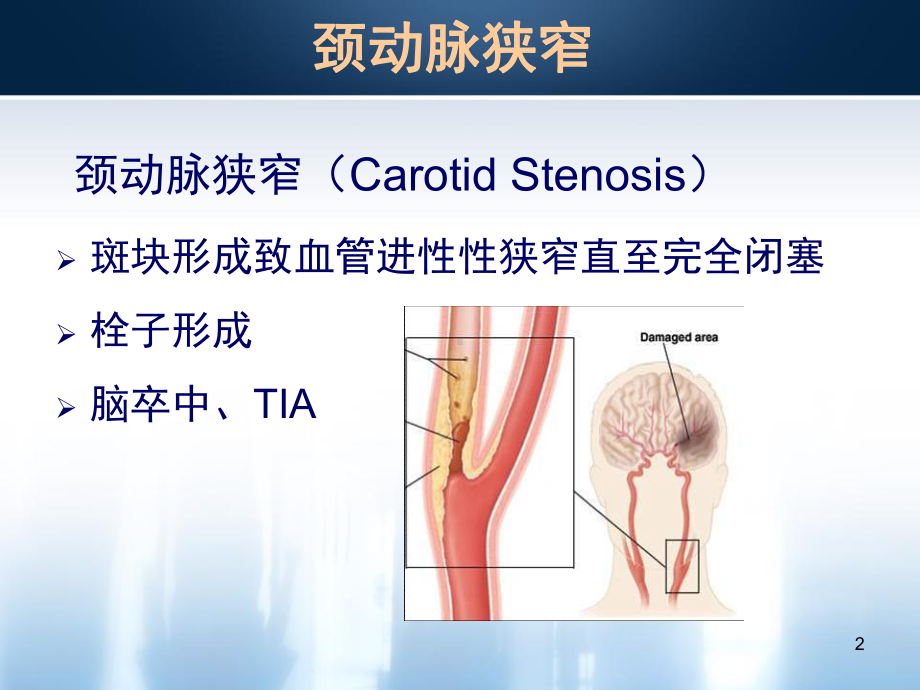 颈动脉内膜剥脱术麻醉管理PPT课件.ppt_第2页