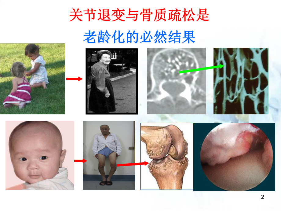 骨关节炎的阶梯治疗医学PPT课件.ppt_第2页