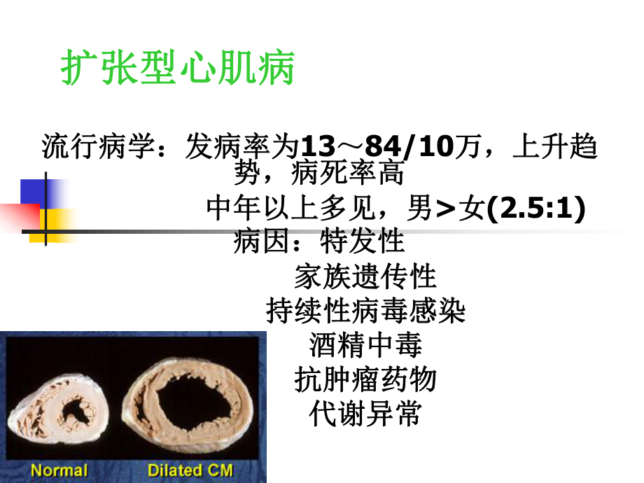 扩张性心肌病护理课件.ppt_第3页