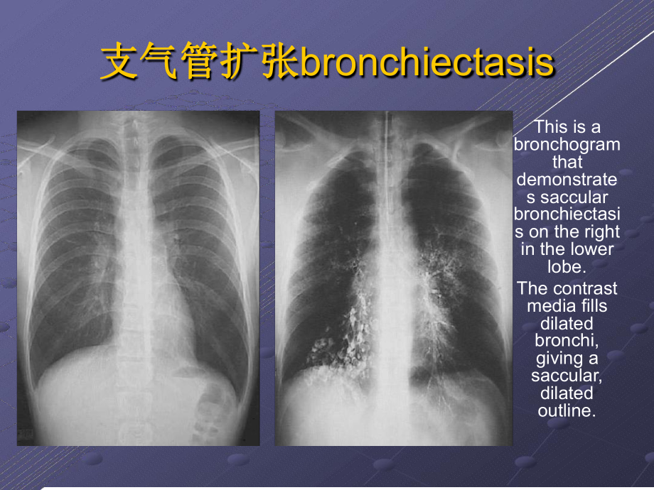 支气管扩张症及咯血护理讲解课件.ppt_第3页