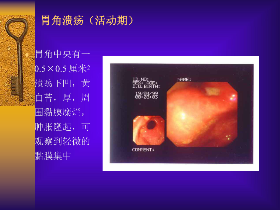 消化性溃疡详解含图课件.ppt_第1页