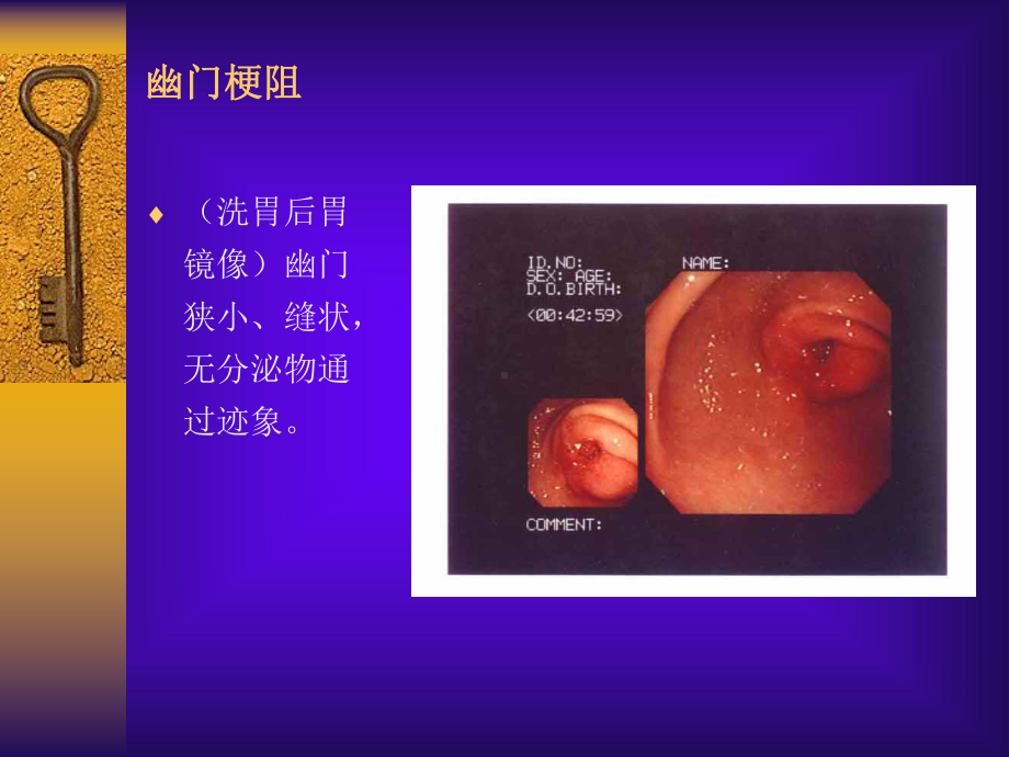 消化性溃疡详解含图课件.ppt_第3页