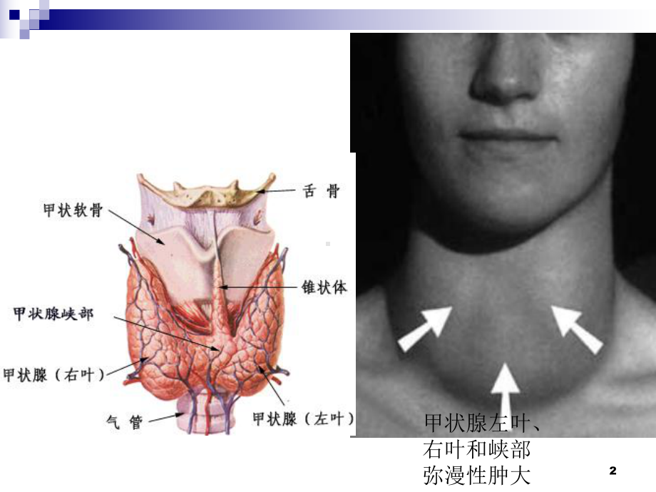 甲亢危象课件.ppt_第2页