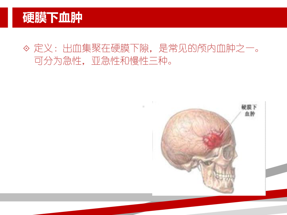 硬膜下血肿的护理查房.ppt课件.ppt_第3页