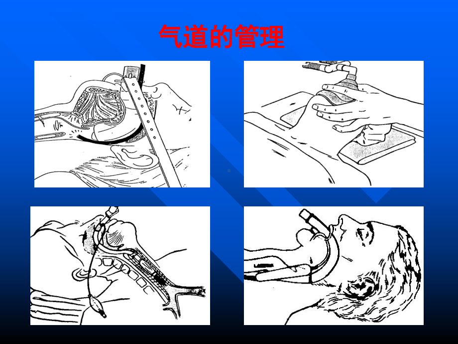 气管及支气管内插管术课件.ppt_第2页