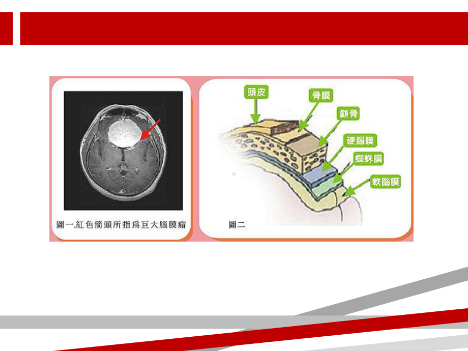 脑膜瘤.ppt课件.ppt_第3页