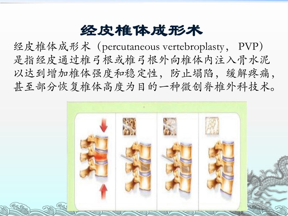 胸腰椎骨折的微创手术治疗讲解课件.ppt_第3页