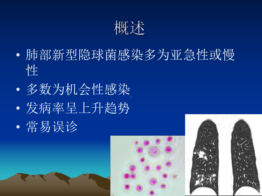 肺隐球菌病的CT诊断分析课件.ppt_第2页