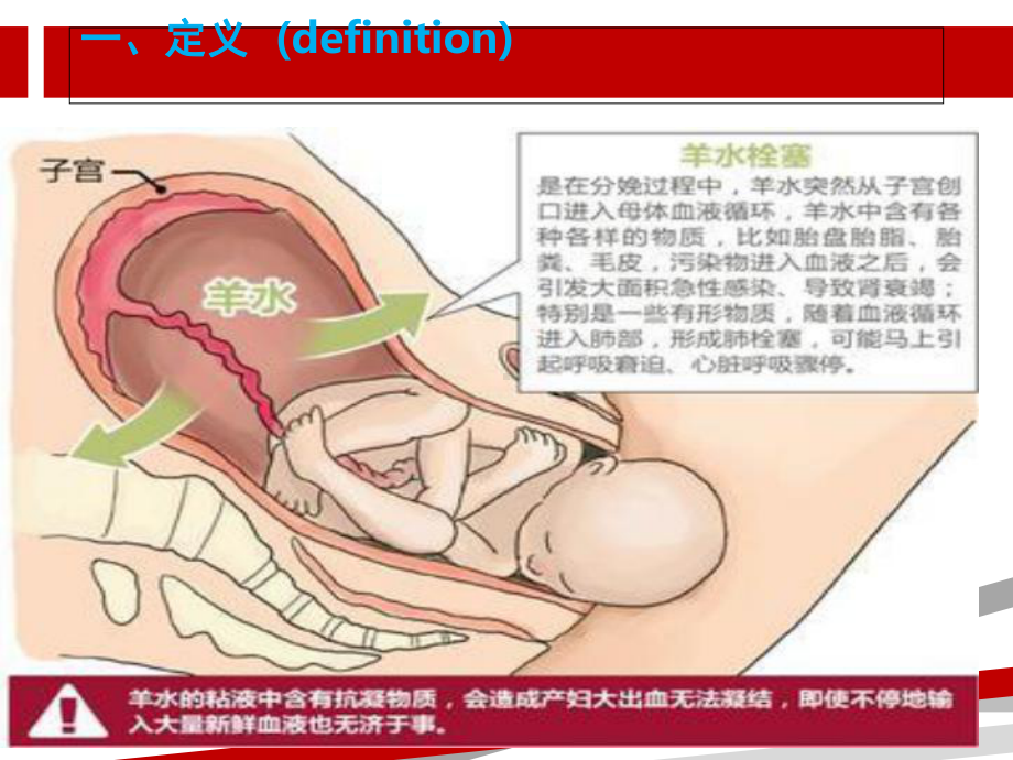 羊水栓塞的护理.ppt课件.ppt_第3页