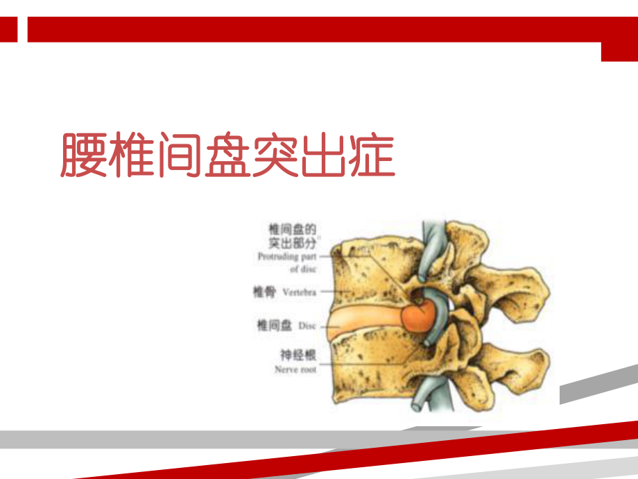 腰椎间盘突出症病人的护理.ppt课件.ppt_第1页