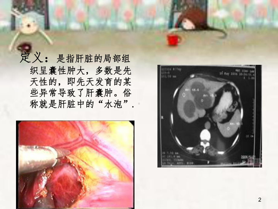 肝囊肿护理查房课件.ppt_第2页