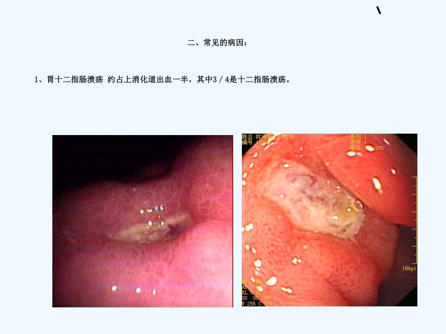 上消化道出血病人的观察与护理课件.ppt_第3页