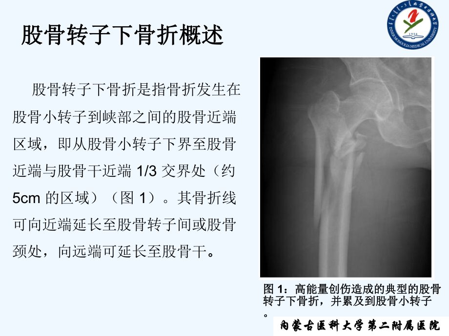 股骨转子下骨折诊疗进展课件.ppt_第2页