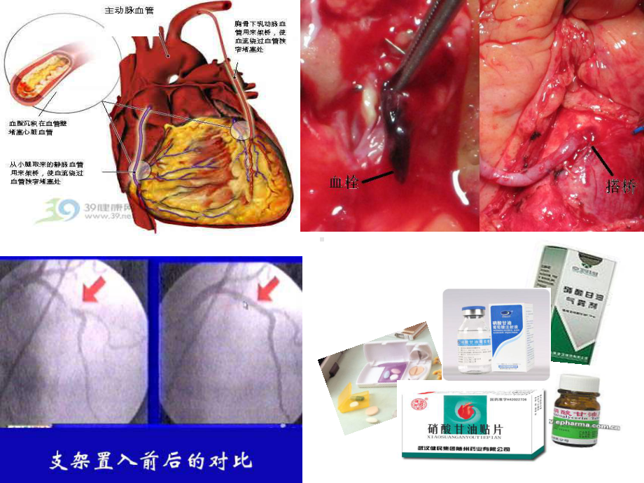 第四节.抗心绞痛药物课件.pptx_第1页