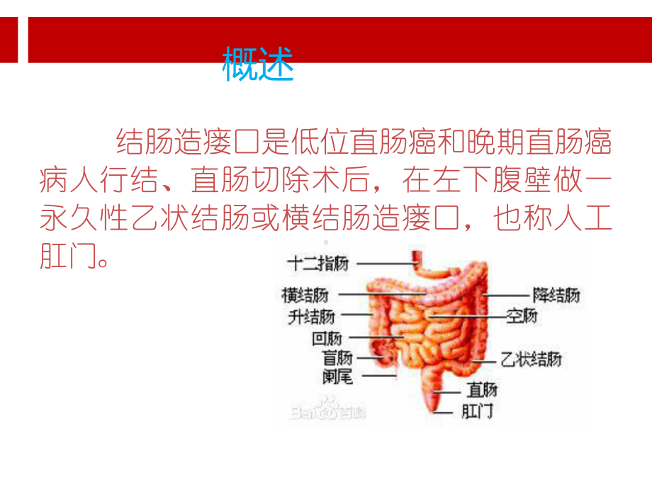 结肠造瘘口的护理.ppt课件.ppt_第2页