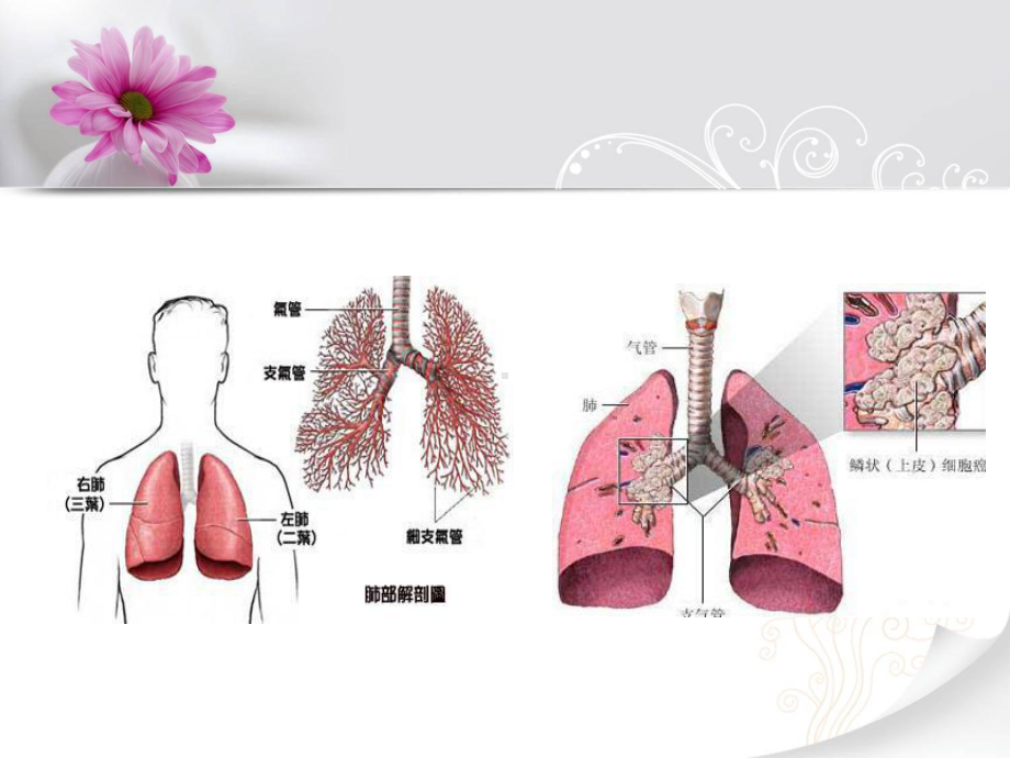 肺癌个案护理查房课件.ppt_第3页