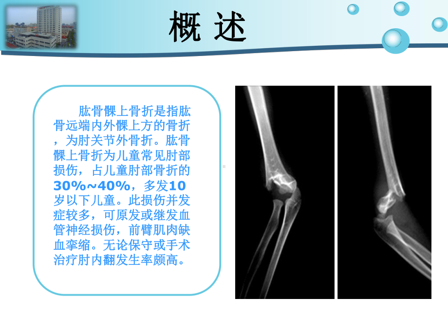 肱骨髁上骨折陈倩课件.ppt_第2页