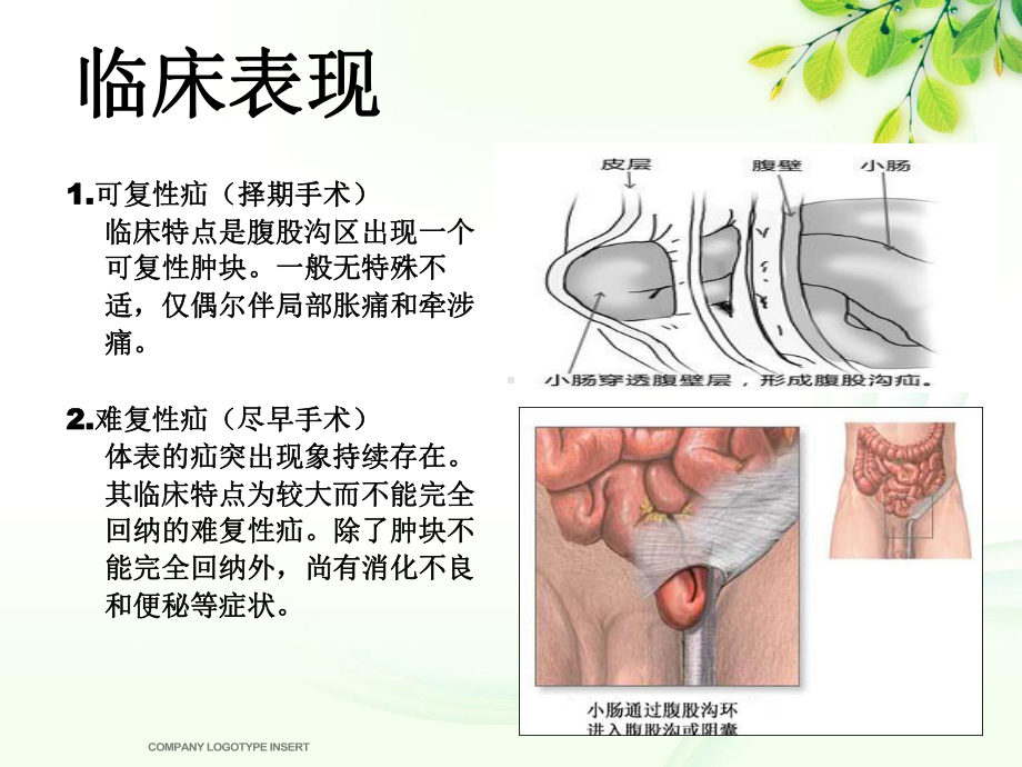 （管理资料）腹股沟斜疝健康宣教汇编课件.ppt_第3页