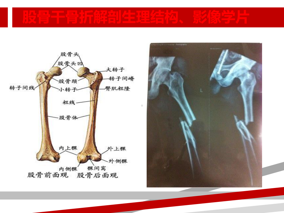 股骨骨折护理查房.ppt课件.ppt_第3页