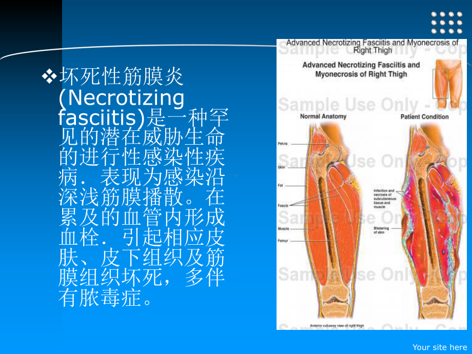 坏死性筋膜炎49390课件.ppt_第2页