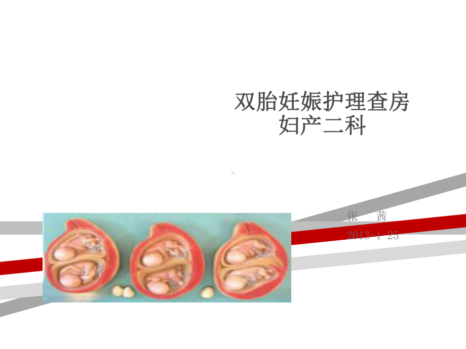 双胎妊娠护理查房.ppt课件.ppt_第1页