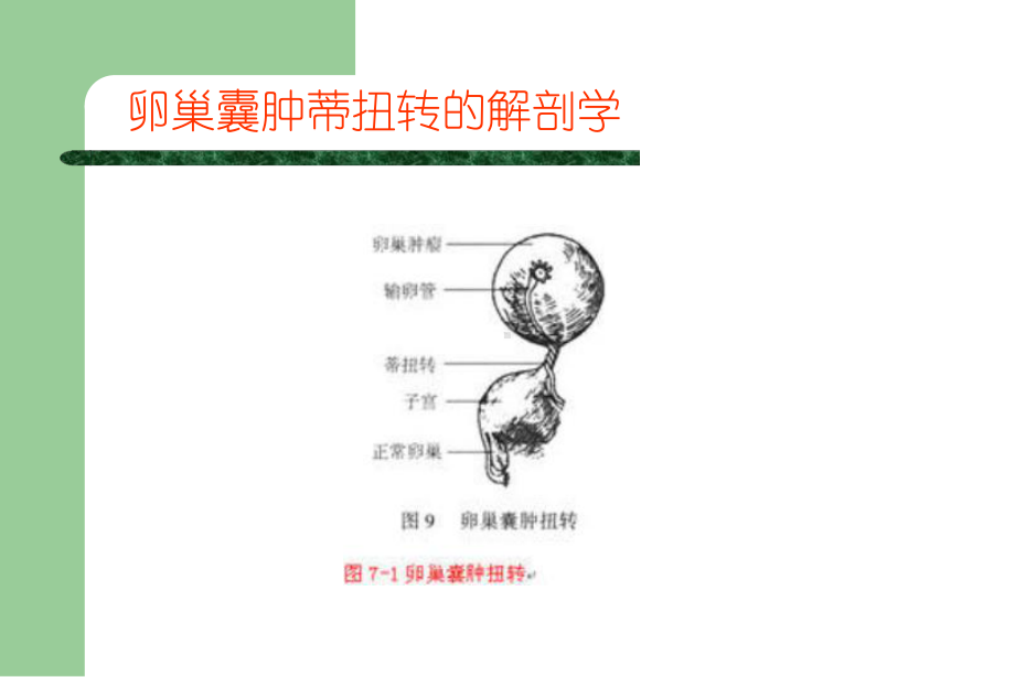 卵巢囊肿蒂扭转PPT课件.ppt_第2页