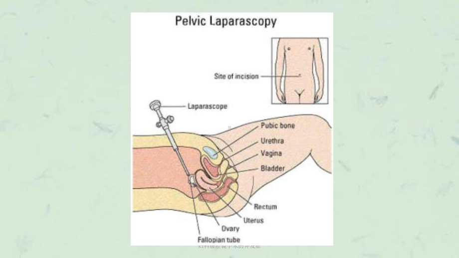 妇科腹腔镜手术的并发症课件.ppt_第2页