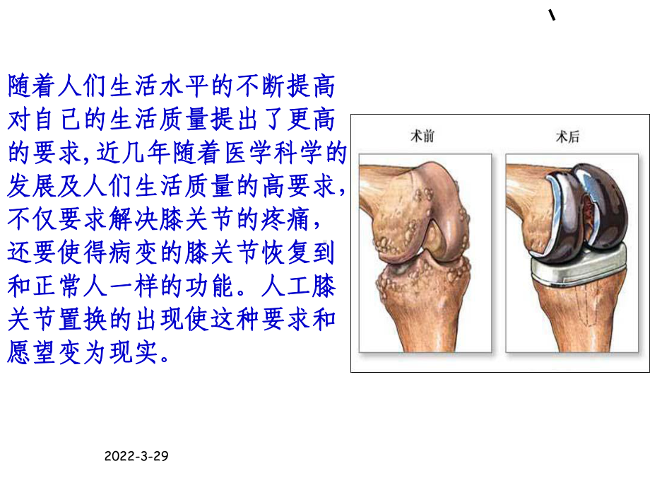 人工膝关节置换适应症及术前最佳状态课件.ppt_第2页