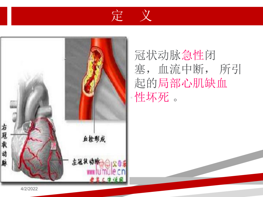 急性心肌梗死的护理查房.ppt课件.ppt_第3页