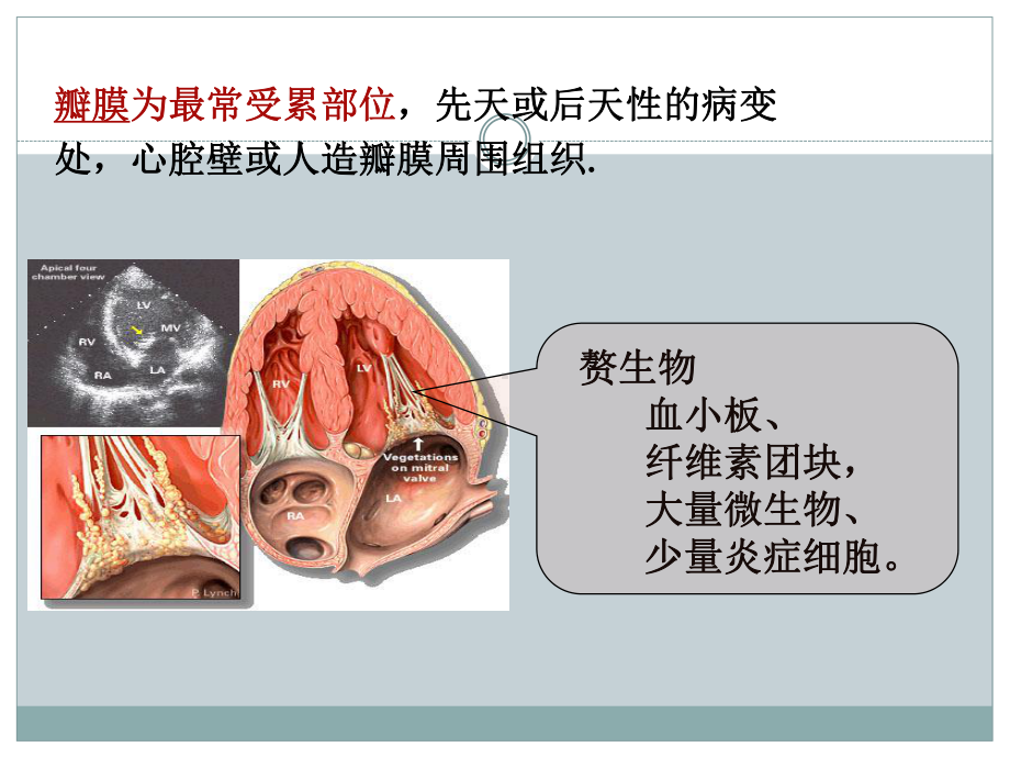 感染性心内膜炎护理查房ppt演示课件.ppt_第3页