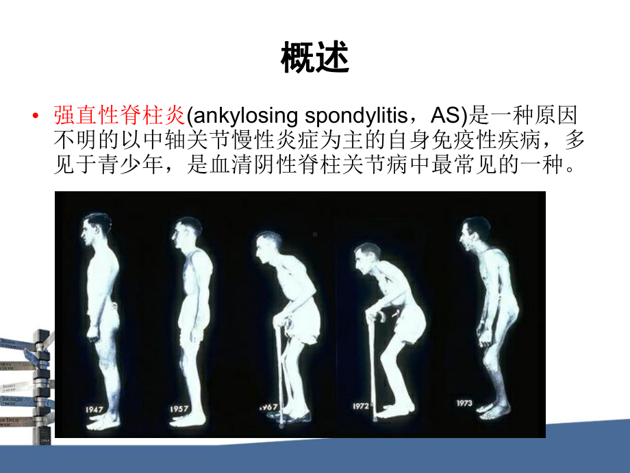 强直性脊柱炎SPARCC评分-影像FTP课件.ppt_第2页